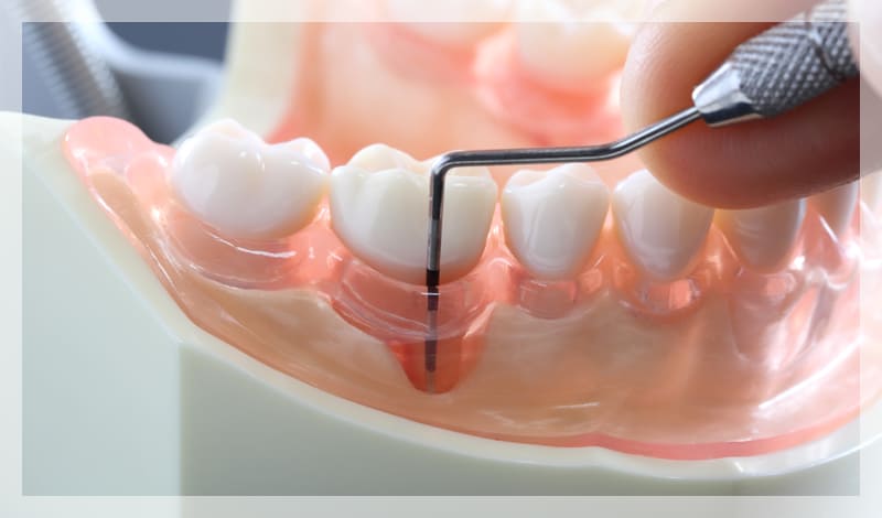 歯周病(歯槽膿漏)